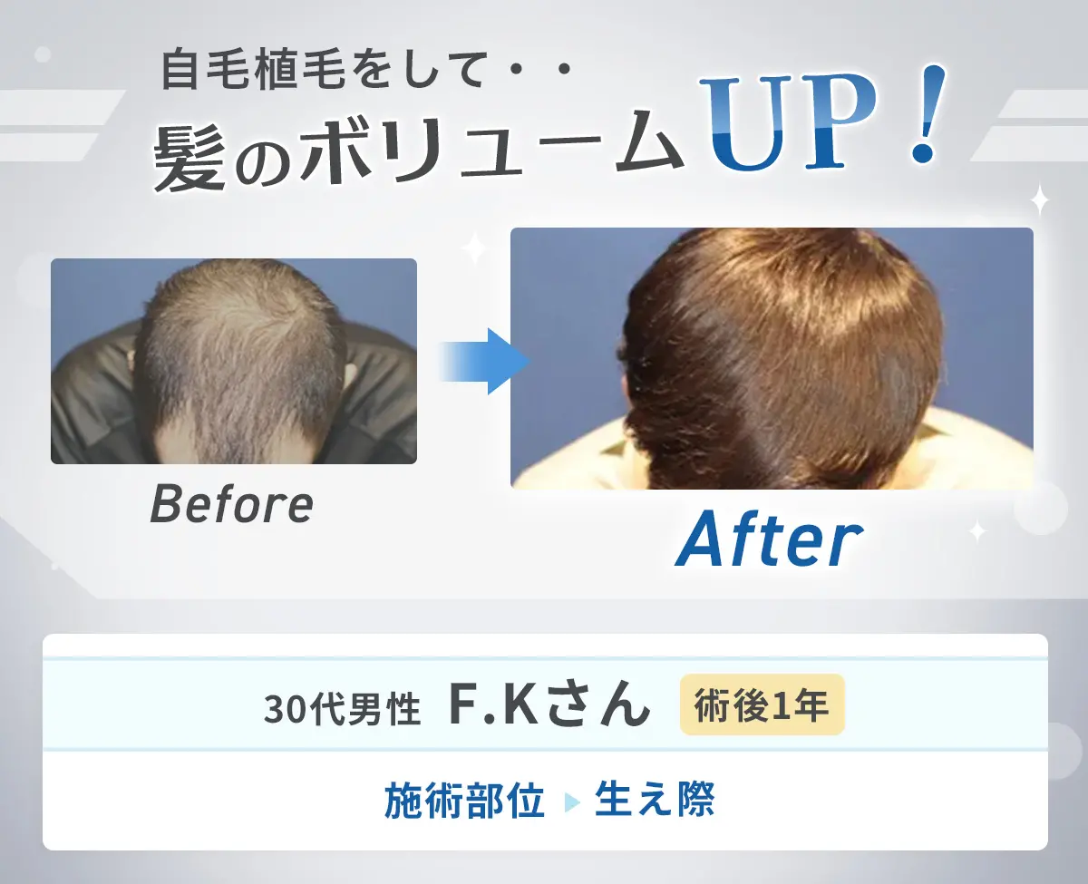 自毛植毛をして・・髪のボリュームUP! before/after