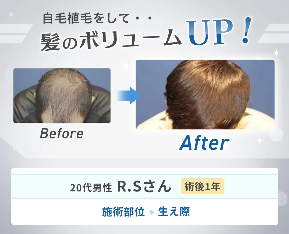 自毛植毛をして・・髪のボリュームUP! before/after