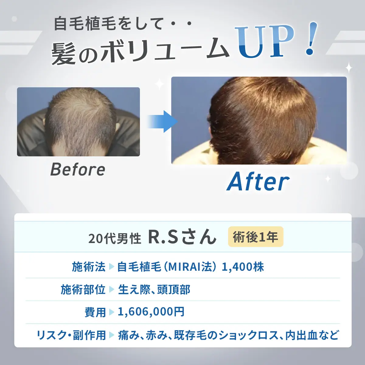 自毛植毛をして・・髪のボリュームUP! before/after 20代男性 R.Sさん 術後1年 施術法 自毛植毛（MIRAI法）1,400株 施術部位 生え際、頭頂部 費用 1,606,000円 リスク・副作用 痛み、赤み、既存毛のショックロス、内出血など